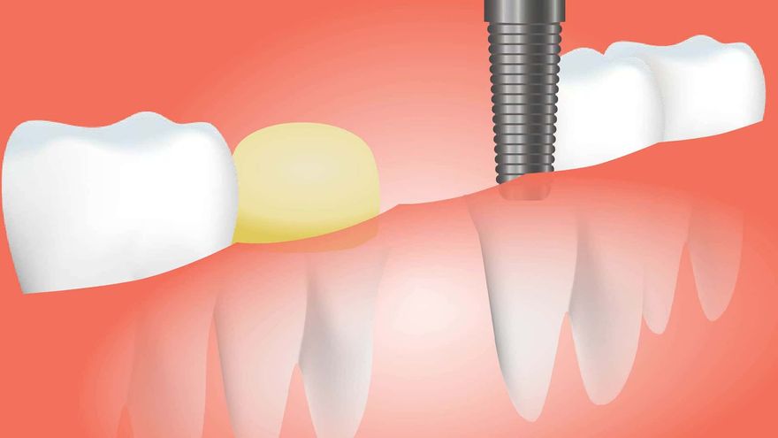Tooth bridge medical dental