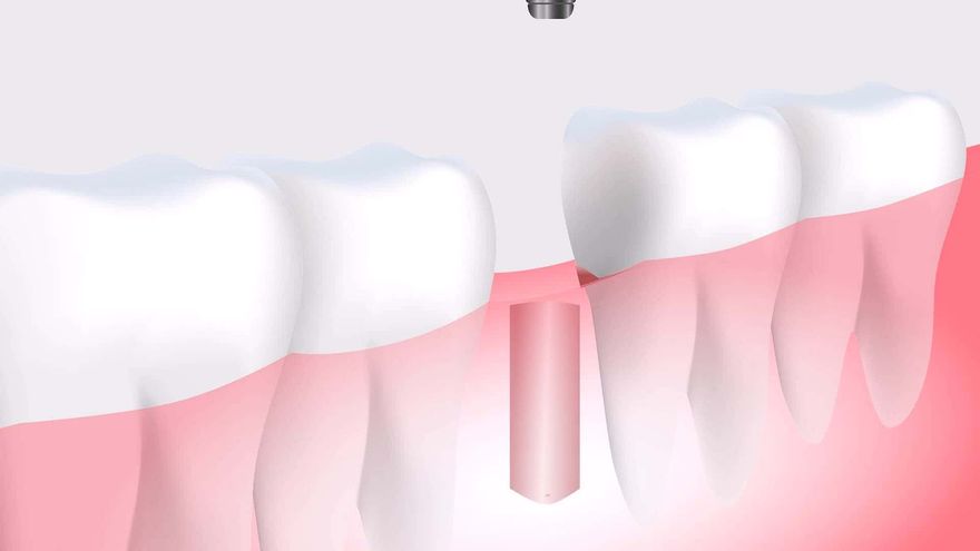 Tooth implant medical surgery
